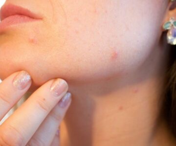 Does Biotin cause acne